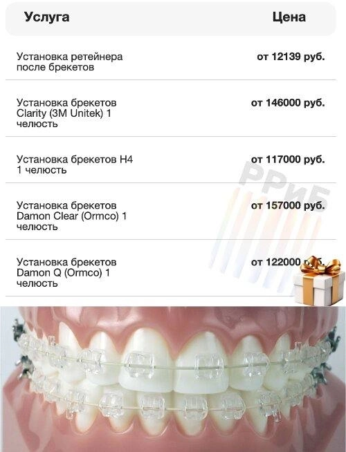 Брекеты подорожали вдвое, теперь полмиллиона стоят.